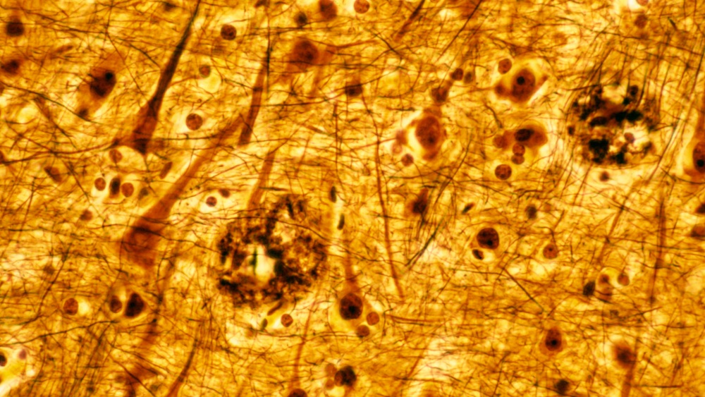 染色された2つの老人斑を示すヒト大脳皮質